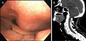 (A) A tumefaction in the posterior wall of hypopharynx and inferior oropharynx visualized by fiberoptic bronchoscopy. (B) Cervical computed tomography (sagittal) showing large cervical anterior osteophytes.