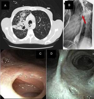 A fistulous tract between the trache and esophagus seen on both CT scan of the chest (A) and barium esophagogram (B). The bronchoscopy images showing the fistulous tract in the distal right posterior trachea (C) which was healed following antituberculous treatment (D).