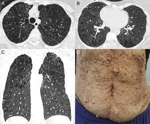 Axial chest CT images obtained with lung window settings at the levels of the upper lobes (A) and lower pulmonary veins (B), and coronal reconstruction (C) showing emphysema with upper lobe predominance and multiple scattered pulmonary cysts, predominantly in the right lung. Note also in (D) multiple cutaneous neurofibromas in the anterior thoracic wall.