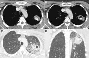 Chest CT image obtained with the mediastinal window setting (A) shows a nodular soft-tissue lesion with internal calcification located in the apicoposterior segment of the left upper lobe (tuberculoma). CT images obtained with the lung window setting (B–D) 8 months later show cavitation of the nodule associated with focal consolidation, ground-glass opacities, and airspace nodules, indicating reactivation and dissemination of the infection.