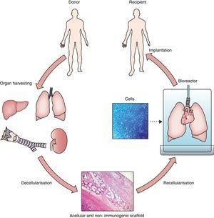 General process of lung bioengineering. A donor lung is decellularized and the organ scaffold is seeded with cells and placed into a bioreactor for lung biofabrication. See text for detailed explanation. Source: Reproduced from Ref. 32, with permission of the copyright owner of The Lancet.