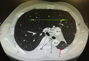 Imagen axial de la TAC de tórax en la que se observa una marcada reducción de volumen del pulmón izquierdo con bronquiectasias en su interior, correspondiente al pulmón hipoplásico (a) y una gran hiperinsuflación compensatoria del pulmón derecho (b); Ao-a: aorta ascendente; Ao-d: aorta descendente; APd: arteria pulmonar derecha; BP: bronquios principales derecho e izquierdo; E: esófago; VCS: vena cava superior; VP: vena pulmonar.
