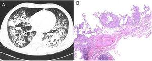 A) TC torácica: consolidaciones pulmonares en lóbulo medio, língula y ambos lóbulos inferiores. B) Biopsia transbronquial basal derecha: presencia de neumonitis granulomatosa no necrosante (tinción hematoxilina-eosina,4x).
