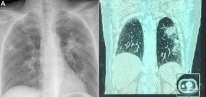 Chest X ray showing abscessus pneumonia (A); HRCT demonstrated extensive pulmonary abscessus over both the lungs (B).