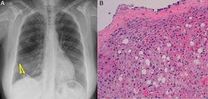 A) La radiografía de tórax muestra 2 nodulaciones supradiafragmáticas izquierdas (flechas). B) Presencia de tejido hepático con leve esteatosis, inmerso en un tejido fibroconectivo tapizado por celularidad mesotelial (pleura parietal diafragmática) (H&E ×20).