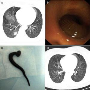 Chest computed tomography showed a ground-glass opacity in the medial basal segment of the right lower lobe (A). Bronchoscopy revealed a brown worm-like moving foreign body almost completely obstructing the lumen of the medial basal segmental bronchus of the right lower lobe (B). The foreign body was identified as a 4cm long living leech (C). Chest computed tomography after 1 week showed the ground-glass opacity in the right lower lobe was almost completely absorbed (D).