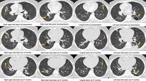 CT scan images showing four representative sections at presentation (first row), 12 months (second row) and 21 months (third row). Arrows indicate the cavitary lesions in the right upper, right lower, lingula and left lower lobes (from left to right).