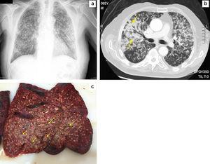 a) Radiografía del tórax. b) TAC torácica. c) Múltiples nódulos pulmonares cavitados en la necropsia.
