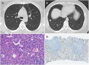 (A) Chest CT showing bilateral pulmonary nodules, predominantly in ground-glass. (B) Chest CT showing a nodule at the base of the right lung, which was biopsied. (C) Photomicrograph illustrating lymphocytes and prominent eosinophilic background; Stain: hematoxylin and eosin (HE); magnification: 40×. (D) Immunohistochemistry photomicrograph showing numerous small-caliber vessels positive for CD34; magnification: 10×.