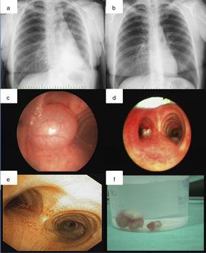Chest X-ray before (a) and after intervention (b), showing disappearance of left lower lobe atelectasis. On bronchoscopy (c), a vegetating, pedunculated lesion covered with a normal bronchial epithelium was obstructing the left main bronchus. Bronchoscopic view after resection (d) and after one month (e). Resected material (f).