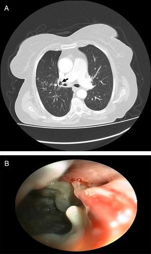 (A) Lung window of the thorax computed tomography revealed tre-in-bud appearance on the anterior segment of the right upper lobe. Black arrow shows bronchonodal fistula. (B) Bronchoscopic view of the bronchonodal fistula located at the right secondary carina (RC1).