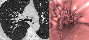 Multidetector computed tomography (MDCT) of the thorax. (A) Axial high resolution MDCT image demonstrates multiple nodular calcifications (white arrows) at the anterior wall of the main bronchi. (B) Virtual bronchoscopy shows nodules (white arrows) involving the anterior and lateral portions of the trachea, with sparing of the posterior wall (arrowheads).