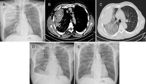 (A) Postero-anterior chest X-ray showing a heterogeneous opacity in the right superior lung lobe. (B) Chest CT showing a subpleural hematoma on the right lung with active bleeding. (C) Chest CT showing subpleural hematoma and scaterred infiltrate on the right upper lobe. (D) Postero-anterior chest X-ray performed at hospital discharge, showing reduction of the hematoma in the right superior lung lobe and right small volume pleural effusion. (E) Postero-anterior chest X-ray performed after 7 months, showing complete disappearance of hematoma.