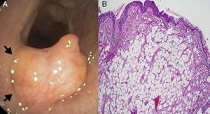 (A) Flexible tracheobronchoscopy showing a well defined, yellowish, smooth, lobulated, broad-based tumour rising from the mucosal layer (arrows) of the anterior tracheal wall. (B) Microscopic image of the resected specimen showing a not encapsulated tumour localized in the subepithelial layer, composed of mature adipocytes without cellular atypia (hematoxylin-eosin).