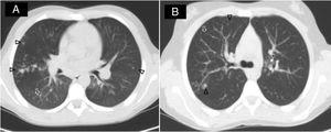 Tac pulmonar de 2 pacientes diagnosticados de infección por M. lentiflavum. Ambos pacientes mostraron en el tac una clara imagen de árbol en brote (⇑) con nódulos acinares (Δ), de predominio en lóbulos superiores derechos.