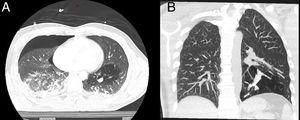 A) Nivel hidroaéreo en un nódulo pulmonar con hiperinsuflación distal en la TC inicial. B) La angio-TC evidenció hiperinsuflación, impactación mucosa intrabronquial e hipovascularización en el lóbulo inferior izquierdo.