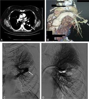 Thoracic CT scan and angiogram images of the pulmonary arteriovenous malformation. (A) The axial thoracic CT image (mediastinal window) shows an aneurysmal sac (arrow), with a connection to a sub-segmental branch of the upper branch of the pulmonary artery. (B) 3D-volume rendering CT image that shows an aneurysmal sac with a connection to a sub-segmental branch of the upper branch of the pulmonary artery, and at the lower end to a pulmonary vein (*). (C) Selective left pulmonary artery branch angiogram showing the pulmonary arteriovenous malformation (arrow). (D) Postembolization pulmonary arteriogram with complete occlusion of the pulmonary arteriovenous malformation.