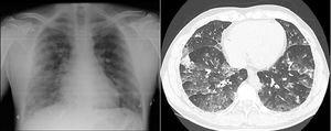 A la izquierda, radiografía de tórax con infiltrados reticuloalgodonosos bilaterales. A la derecha, angio-TC torácica (ventana parénquima) en la que se aprecian opacidades alveolares, así como en vidrio deslustrado, de distribución bilateral.