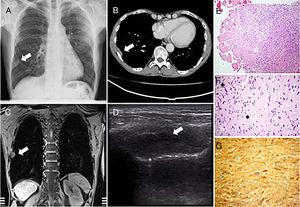 tomografia de pulmon con contraste