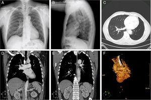 Radiografía de tórax, proyección posteroanterior (A) y lateral (B). TC axial de tórax con ventana de parénquima a nivel de venas pulmonares (C). Reconstrucción coronal a nivel de vasos pulmonares (D y E). Reconstrucción vascular (F).