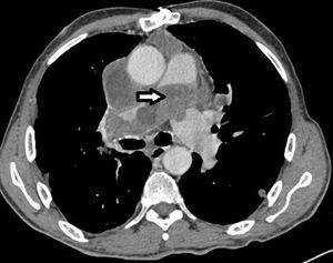 Computed tomography thorax.