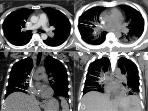 Axial (A) contrast-enhanced chest computed tomography image showing a filling defect (thrombus) on the left pulmonary artery. Axial (B) and coronal (C and D) reformatted images with maximum intensity projection show multiple metallic fragments (from the fractured filter) at the level of the right cardiac cavities and right pulmonary artery (arrows). Note also non-homogeneous opacities in the left lower lobe (pulmonary infarction) and a deep venous catheter in the superior vena cava (arrowheads).