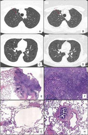 Chest HRCT scans showing diffuse cystic lung disease and a solitary pulmonary nodule (red arrow) in the beginning of follow-up (A and C) and five years later (B and D). (A) Regular and thin-walled pulmonary cysts and a 10mm pure ground-glass nodule in the right upper lobe. (B) CT image at the same level as Fig. 1A after five years of follow-up showing a significant increase in the size of the nodule (13mm) and change in its composition (a solid nodule). (C) Random and multiple thin-walled cysts. (D) Stability of diffuse pulmonary cysts five years later. (E) A low-power view of the tumor with a dense area of scarring. (F) Invasion area with desmoplastic tissue, irregular glands and micropapillae. (G) Constricted airway and peribronchiolar alveolar overdistension. (H) Bronchiole with submucosal fibrosis and focal inflammatory cell infilltrate. (H&E stains, original magnification (A) ×10, (B) ×50, (C) ×40 and (D) ×100).