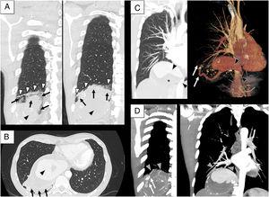 (A) Thorax CT scan coronal images in two different planes (parenchymal window) showing atelectatic sequestrated lung (black arrows), pleural line totally separating normal lung parenchyma from underlying sequestrated lung (white arrowheads with black outline) and the lumen of the aneurysm (black arrowhead with grey outline). (B) Thorax CT scan axial image (parenchymal window) showing atelectatic sequestrated lung (black arrows) and the lumen of the aneurysm (black arrowhead with grey outline). (C) On the left – thorax CT scan coronal image (oblique maximum intensity projection [MIP] image) showing part of the aberrant systemic artery supplying sequestrated lung: an anomalous small arterial branch stemming from the posterior aspect of the descending thoracic aorta (black arrowhead with grey outline on the right), the lumen of the vessel inside the aneurysm (black arrowhead with grey outline on the left) and a peripheral hypodense component inside the aneurysm, suggesting mural thrombosis (black asterisk). On the right – volume rendered CT scan of the lumen of the same aberrant artery. Note that black arrowheads with grey outline roughly point to the same parts of the artery which are marked on the left part of figure C. White arrows mark the distal end of the vessel towards sequestrated lung parenchyma. (D) Thorax CT scan coronal images (oblique MIP image) showing other details regarding vascularization of sequestrated lung. Note that white arrows roughly point to the same parts of the artery which are marked on the right part of figure C. Grey arrowheads mark two almost parallel veins stemming from sequestrated lung parenchyma, converging towards pulmonary veins and finally draining to the left atrium.