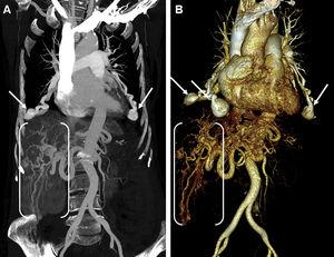 Coronal MIP image (A) and anterior view volume rendering 3D (B) thoracoabdominal CT angiographies showing multiple pulmonary (arrows) and hepatic arteriovenous malformations (between brackets).