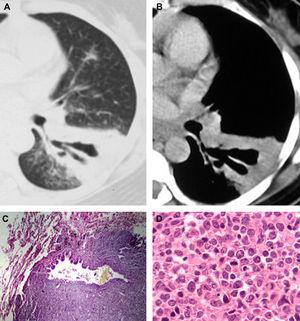 A 45-year-old woman with biopsy-proven BALT lymphoma. Axial computed tomography with the lung (A) and mediastinal (B) window settings showing an area of consolidation in the left lower lobe containing a markedly dilated bronchus. In (C), histopathological section demonstrating a dilated bronchiole with peribronchiolar infiltration of neoplastic cells (hematoxylin and eosin stain, magnification 40×). In (D), histological section showing proliferation of lymphoid cells (hematoxylin and eosin stain, magnification 400×).