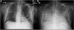 Chest X-ray on admission and at 12-h follow-up. (A) Bibasilar linear infiltrates seen on admission. (B) Diffuse bilateral alveolar infiltrates with air bronchogram seen 12h after admission.