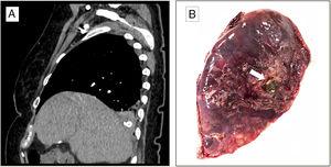 A) Imagen sagital de la tomografía computarizada que muestra cuerpo extraño con densidad calcio ubicada en el lóbulo inferior derecho. B) Imagen de la resección pulmonar donde se visualiza el cálculo biliar (flecha).