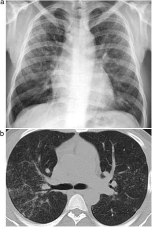 Radiografía de tórax (A) y TCAR (B) de tórax de un trabajador de 33 años donde se observa patrón intersticial difuso de predominio micronodular acompañado de amplias áreas de vidrio deslustrado.