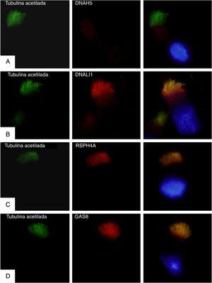 Análisis por inmunofluorescencia de la ultraestructura ciliar. En la primera columna se muestra la presencia de cilios en la célula mediante tubulina acetilada (en verde), en la segunda el resultado de la incubación con anticuerpos primarios contra las proteínas ciliares (en rojo) y en la tercera el merge de la tubulina con cada proteína ciliar y el núcleo marcado con DAPI (azul). A)Ausencia de la proteína DNAH5 (componente de brazos externos de dineína) en el axonema ciliar. B-D)Presencia y colocalización de la tubulina y las proteínas del axonema ciliar (en amarillo): B)DNALI1 (componente de brazos externos de dineína); C)RSPH4A (componente brazos radianes), y D)GAS8 (componente de la nexina-complejo regulador de la dineína).