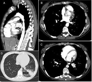 Chest computed tomography and angiography with sagittal (A) and axial (B) reconstructions showing: A (arrow) – an abnormal artery from the thoracic aorta to supply the left lower lobe of the lung; B (arrow) – the left inferior pulmonary vein receiving the drainage from the lobe defining an intralobar sequestration; C (arrow) – both the aberrant artery branch (#) and the inferior pulmonary vein (*) parallel to each other; D (arrow) – a heterogeneous density of the pulmonary parenchyma surrounded by ground glass opacity corresponding to the affected left lower lobe of the lung.