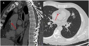 A) Tomografía computarizada, corte sagital. Presencia de aire en aorta torácica ascendente. B) Tomografía computarizada, corte coronal. Presencia de aire en arteria coronaria derecha.
