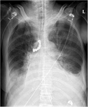 Anterior–posterior chest X-ray demonstrating the radiopaque 7-unit dental prosthesis (arrow) in the patient's right main bronchus.