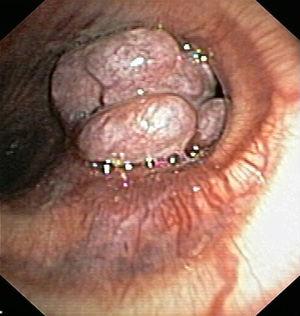 Imagen obtenida durante la broncoscopia donde destaca la presencia de una tumoración polilobulada a la entrada del bronquio principal izquierdo.