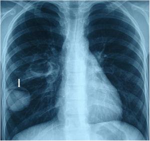 Moon sign is seen on the posteroanterior chest X-ray (arrow).