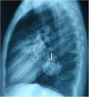 Moon sign is seen on the lateral chest X-ray (arrow).