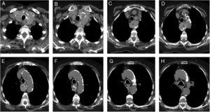 Non-contrast consecutive CT scans of the chest demonstrated a large calcified mass (asterisk). The mass extends to carina level.