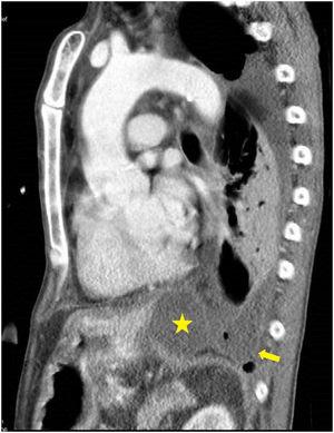 Reconstrucción sagital oblicua de la TC: se observa la colección líquida abdominal en una posición anterior (estrella) comunicada con el derrame pleural izquierdo (flecha gruesa) en una localización posterior.
