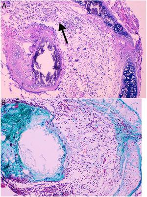 (A) Histological findings in groups than received BMSC. These findings consist in a large number of neovessels in a very loose collagen bed (25×, H–E). The arrow is pointing to a one of the neovessels. (B) Next section of the same histologic sample showing the loose collagen tissue (green color) with trichrome staining (25×).