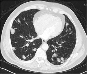 Axial thoracic CT scan with lung parenchyma window of a 74-year-old male patient showing multiple lesions in the bilateral lung parenchyma. Some of the lesions show a tendency to cavitization and some show a tendency to conglomeration. Parenchymal lesions tend to have peri-pleural localization in the lung periphery. The patient has been followed for 6 years due to PAE.