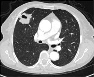 Axial thoracic CT scan with lung parenchyma window of a 61-year-old female patient showing a metastatic mass with a diameter greater than 3cm, mimicking a mass lesion located adjacent to the pleura in the right lung with central cavity and peripheral spicular extensions. The patient has been followed for 4 years due to PAE.