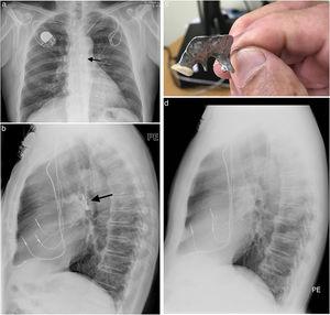 (a) Postero-anterior view of chest X-ray showing the foreign body (prosthetic teeth – black arrow) in the trachea/left main bronchus. Also, a pacemaker and the pacemaker electrodes are seen. (b) Lateral view of chest X-ray showing the foreign body (prosthetic teeth – black arrow) in the trachea/left main bronchus. Also, a pacemaker and the pacemaker electrodes are seen. (c) Prosthetic teeth hold on hand for scale. (d) Lateral view of chest X-ray showing no foreign body (prosthetic) in the trachea/left main bronchus. Also, a pacemaker and the pacemaker electrodes are seen.