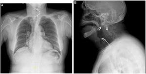 Chest radiograph (posteroanterior and lateral views) – a metal radiopaque foreign body is projected over the midline at the C4–C7 level, consistent with dental prosthesis. No cutaneous emphysema, pneumothorax, athelectasy ou parenchymatous alterations are identified.