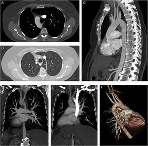 (A) Axial CT scan (mediastinal window) shows right-sided aortic arch. (B) Axial CT scan (parenchymal window) reveals a variant azygos lobe on the left hemithorax and aberrant left subclavian artery. (D and E) Coronal plan MIP CT images show total transposition of visceral organs accompanied with dextrocardia. (C, D and F) Sagittal, coronal and posterolateral projection 3D CT images show aberrant left subclavian artery originated from the distal of the right aortic arc. (E) Coronal MIP CT scan reveals origination and trace of the right and left carotid arteries.