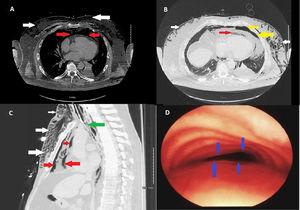 (A) Axial view computed tomography of chest (mediastinal window) showing pneumomediastinum (red arrows) and subcutaneous emphysema (white arrows). (B) Axial view computed tomography of chest (lung window) showing pneumomediastinum (red arrows), subcutaneous emphysema (white arrows) and left basal pneumothorax (yellow arrows). (C) Sagittal view computed tomography of chest (lung window) showing pneumomediastinum (red arrows), subcutaneous emphysema (white arrows) and complete collapse of trachea distal to endotracheal tube (ETT) tip (green arrows). (D) Bronchoscopic view showing complete collapse of anterior tracheal wall (blue arrows) typical of tracheomalacia.