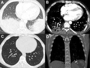 (A) Chest CT image obtained with the lung window setting shows consolidations and ground-glass opacities in both lower lobes. (B) Angio-CT demonstrated no filling defect in the pulmonary arterial system. (C) Chest CT image obtained 1 month after discharge shows complete resolution of the pulmonary opacities. (D) Coronal reconstruction with the bone window setting demonstrates a small and calcified spleen (arrowheads) and H-shaped vertebral bodies with central endplate depressions (arrows).